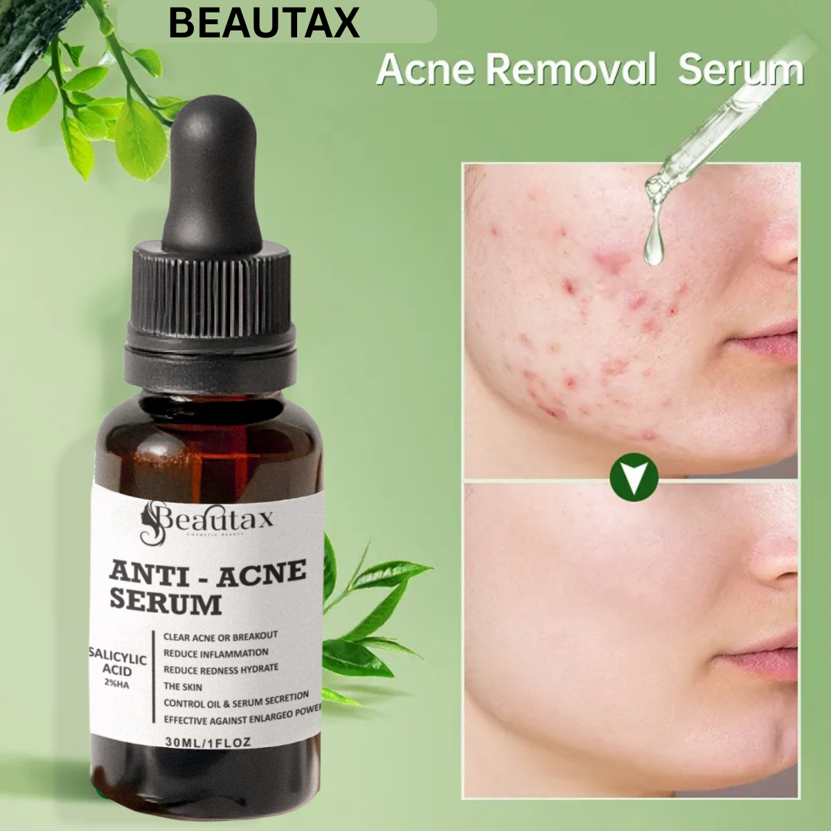 Anti Acne Serum For All Types of Skin