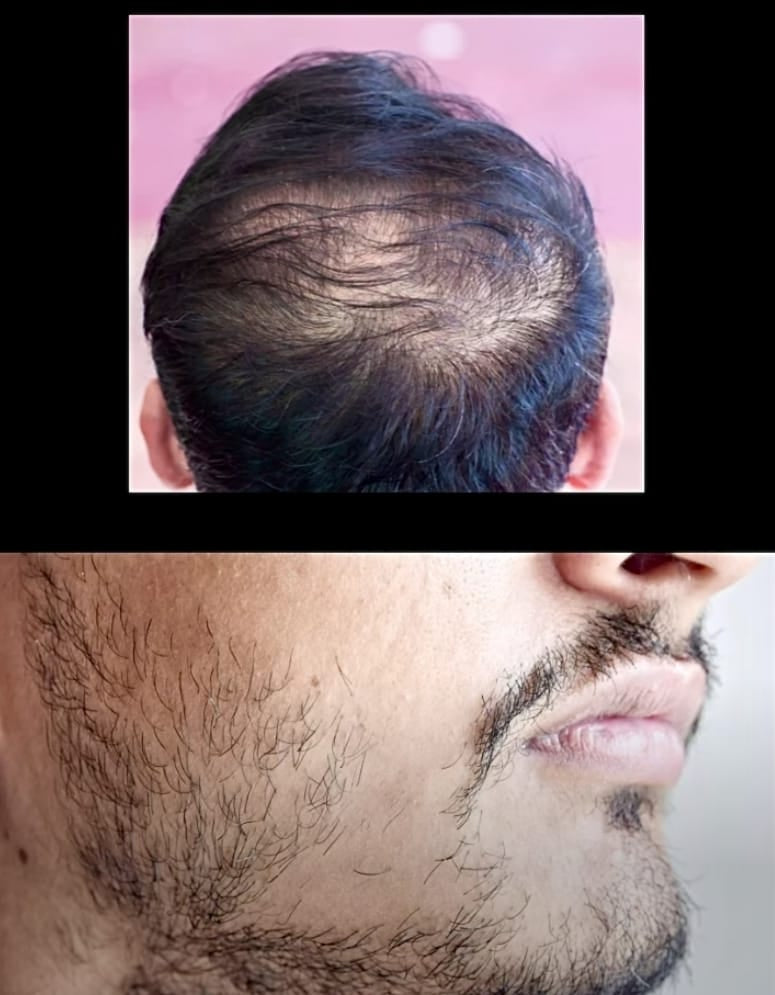 Hair Growth Serum + Derma Roller (30ML)